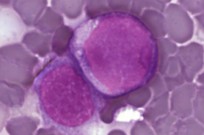 Leukemia cells dividing. Photo courtesy of Public Library of Science