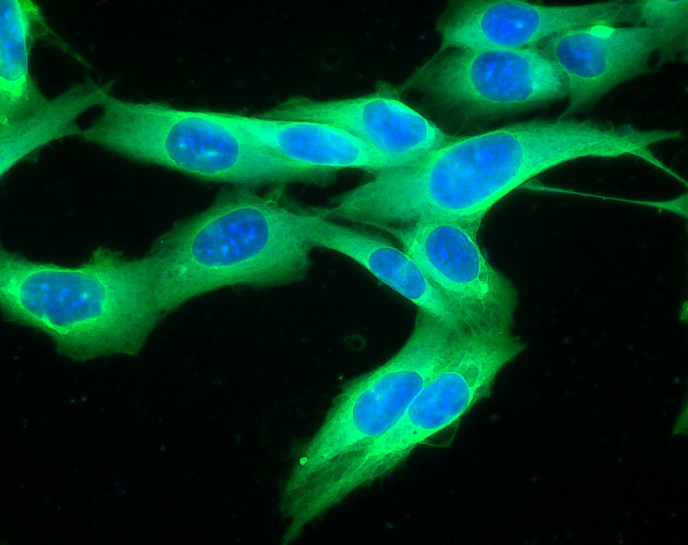 New Weizmann Instititue research could halt melanoma in its tracks. Pictured here: human melanoma cell line growing in tissue culture. (Shutterstock.com)