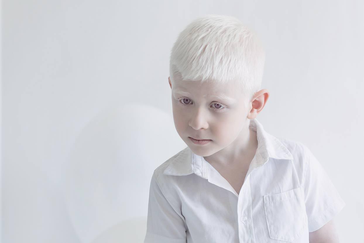 Whitehair babyboy与白化症综合症状 库存照片. 图片 包括有 男人, 背包, 逗人喜爱, 人员 - 86293558