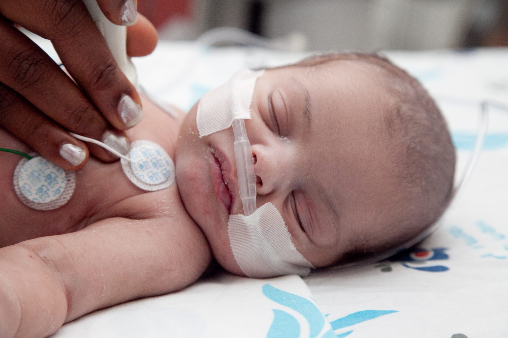 A baby from Gaza receives treatment in Israel from Save a Child’s Heart.