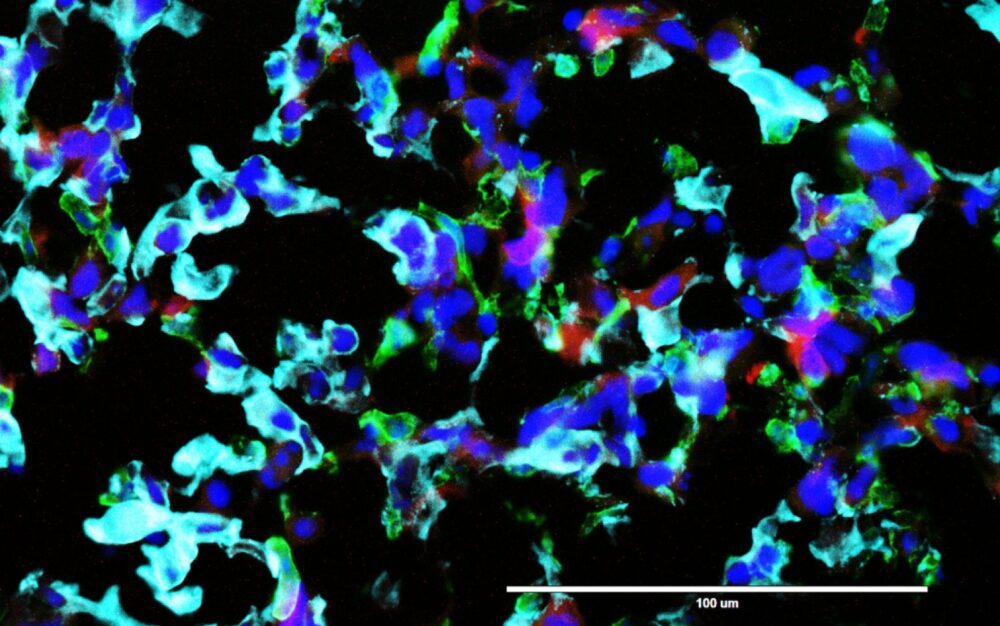Glioblastoma cells. Image courtesy of TAU